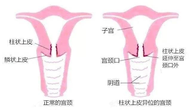 别再辗转反侧,宫颈糜烂不是病